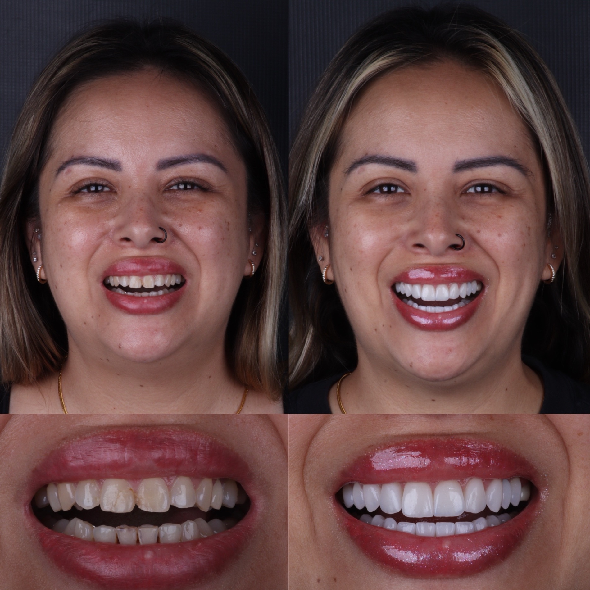 Caso real 01 — antes e depois, Dra. Paola Abe