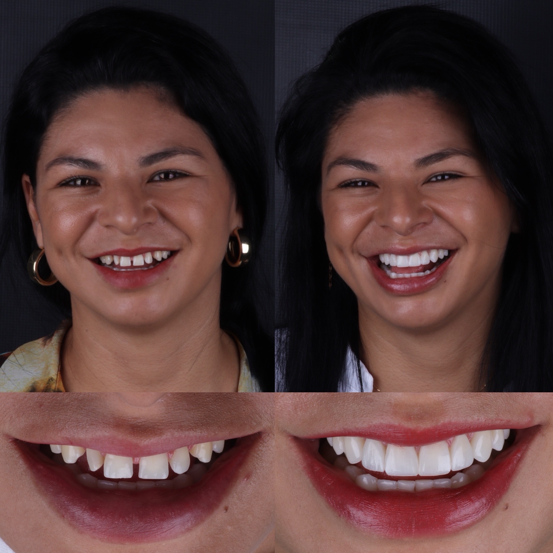 Caso real 03 — antes e depois, Dra. Paola Abe
