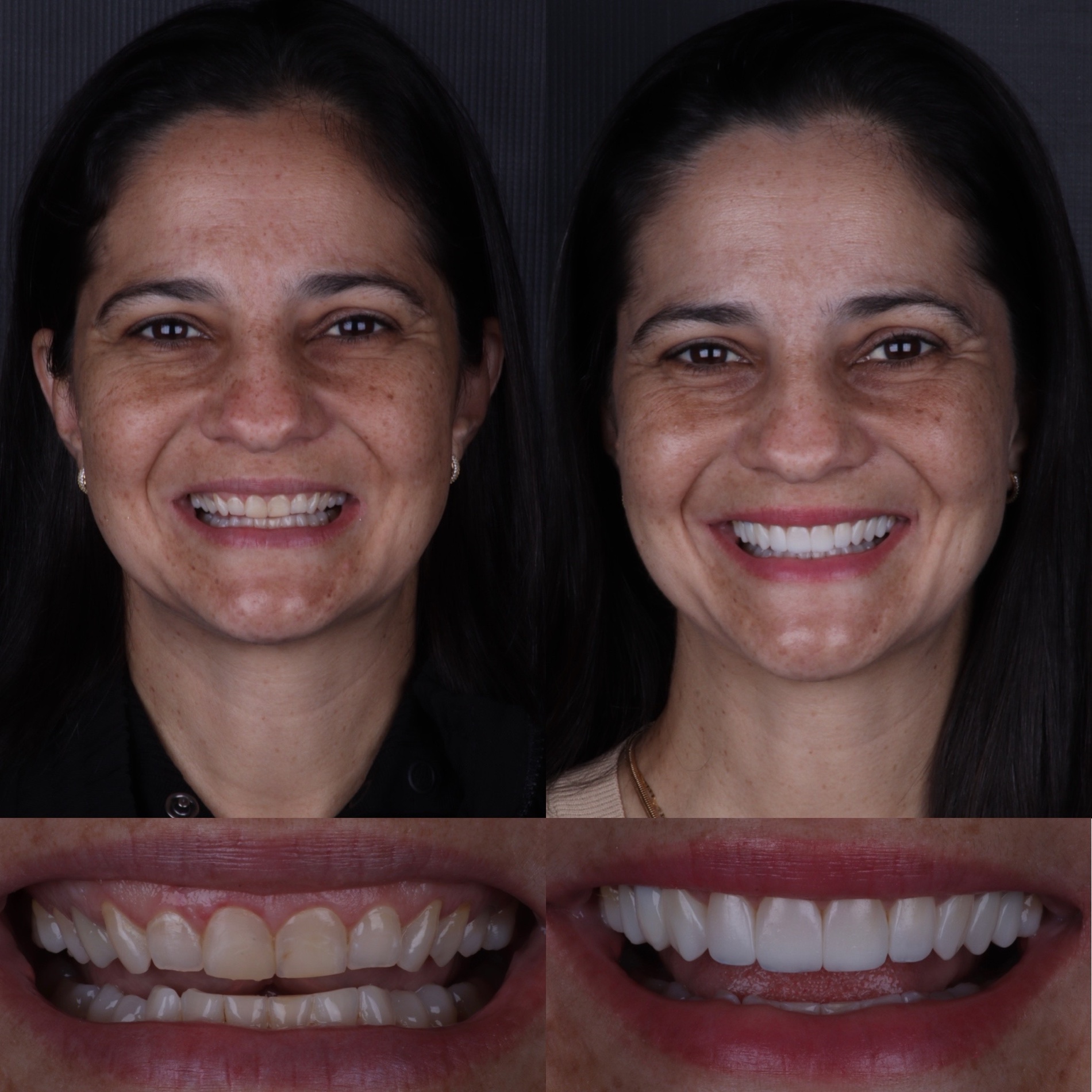 Caso real 04 — antes e depois, Dra. Paola Abe