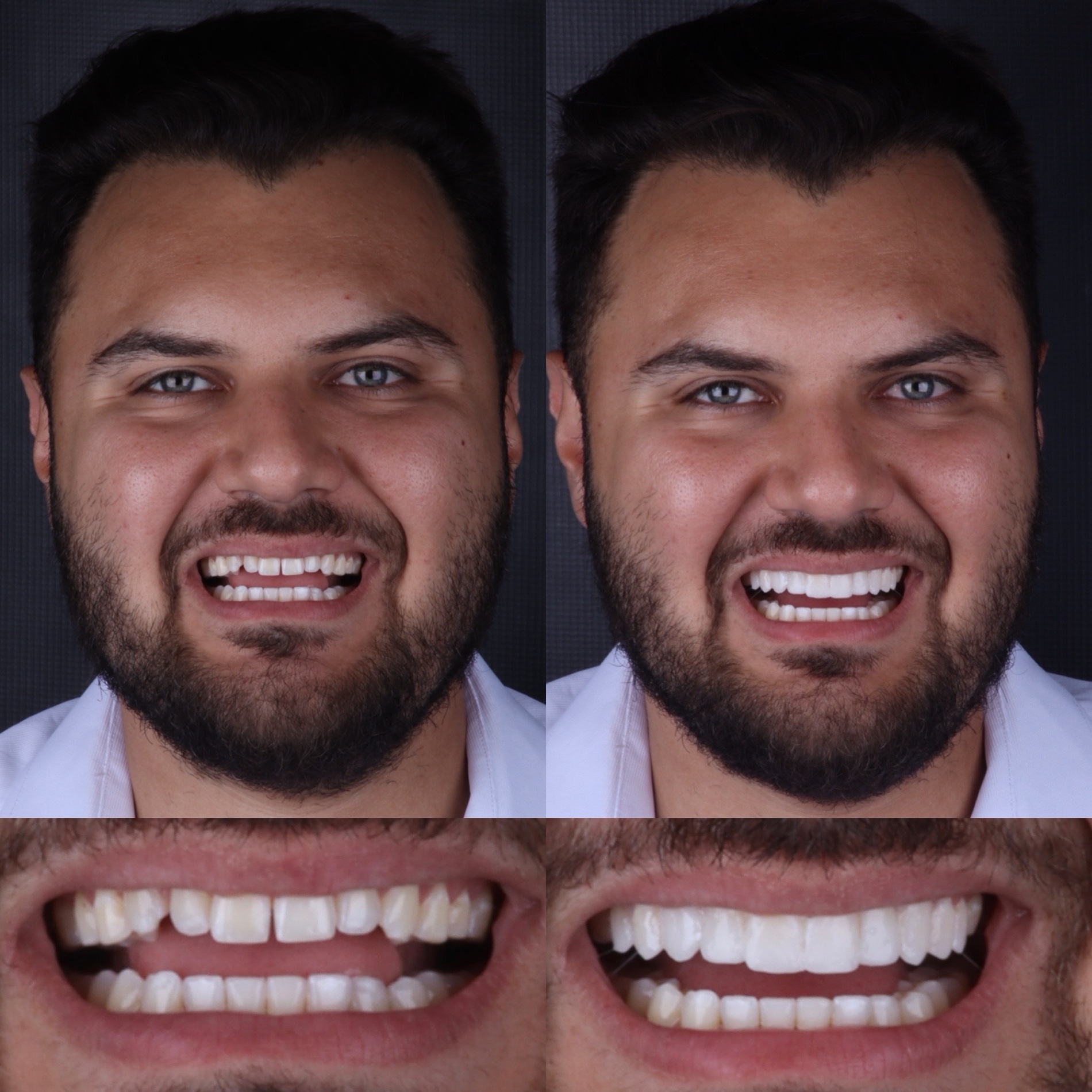 Caso real 05 — antes e depois, Dra. Paola Abe