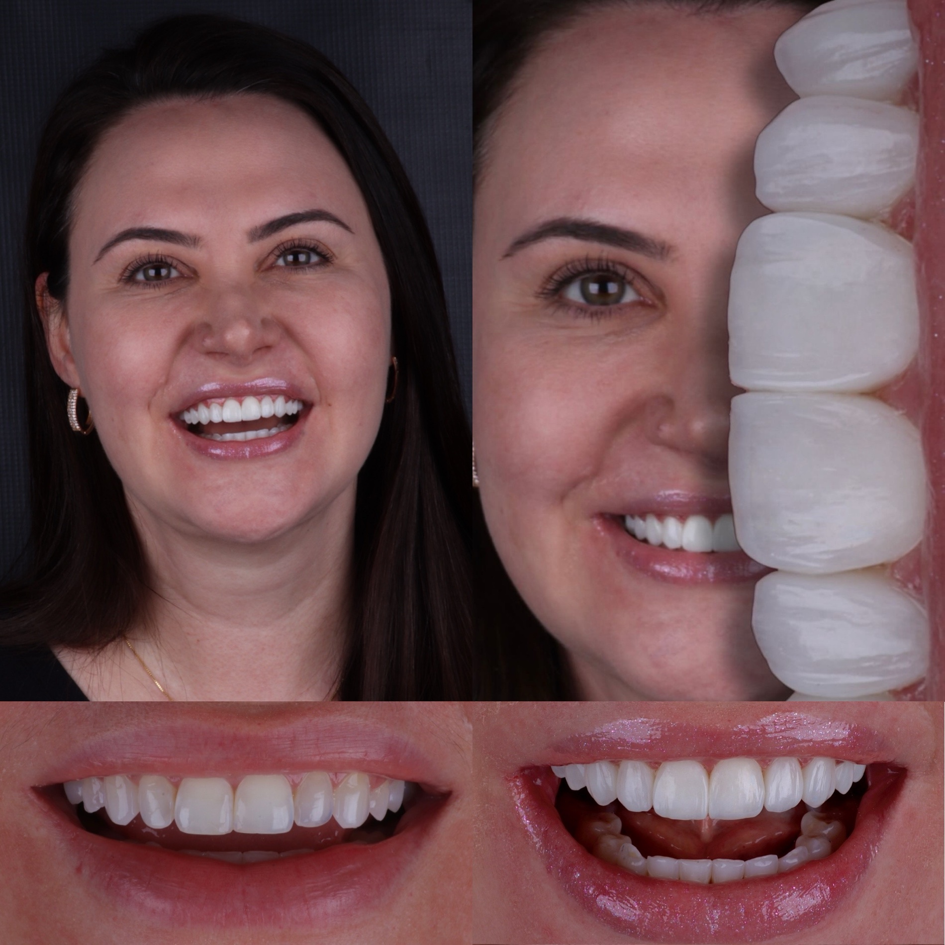 Caso real 06 — antes e depois, Dra. Paola Abe