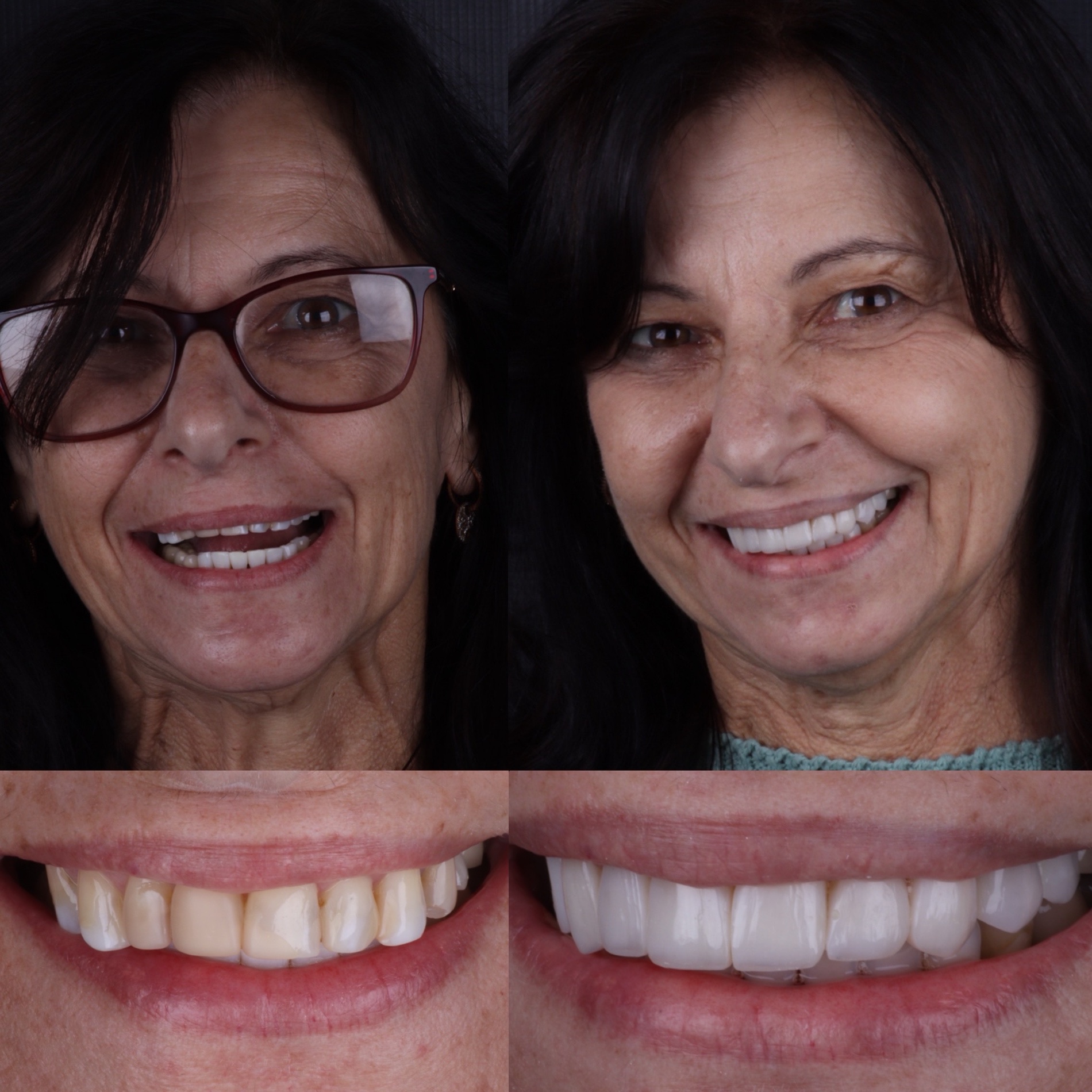 Caso real 07 — antes e depois, Dra. Paola Abe