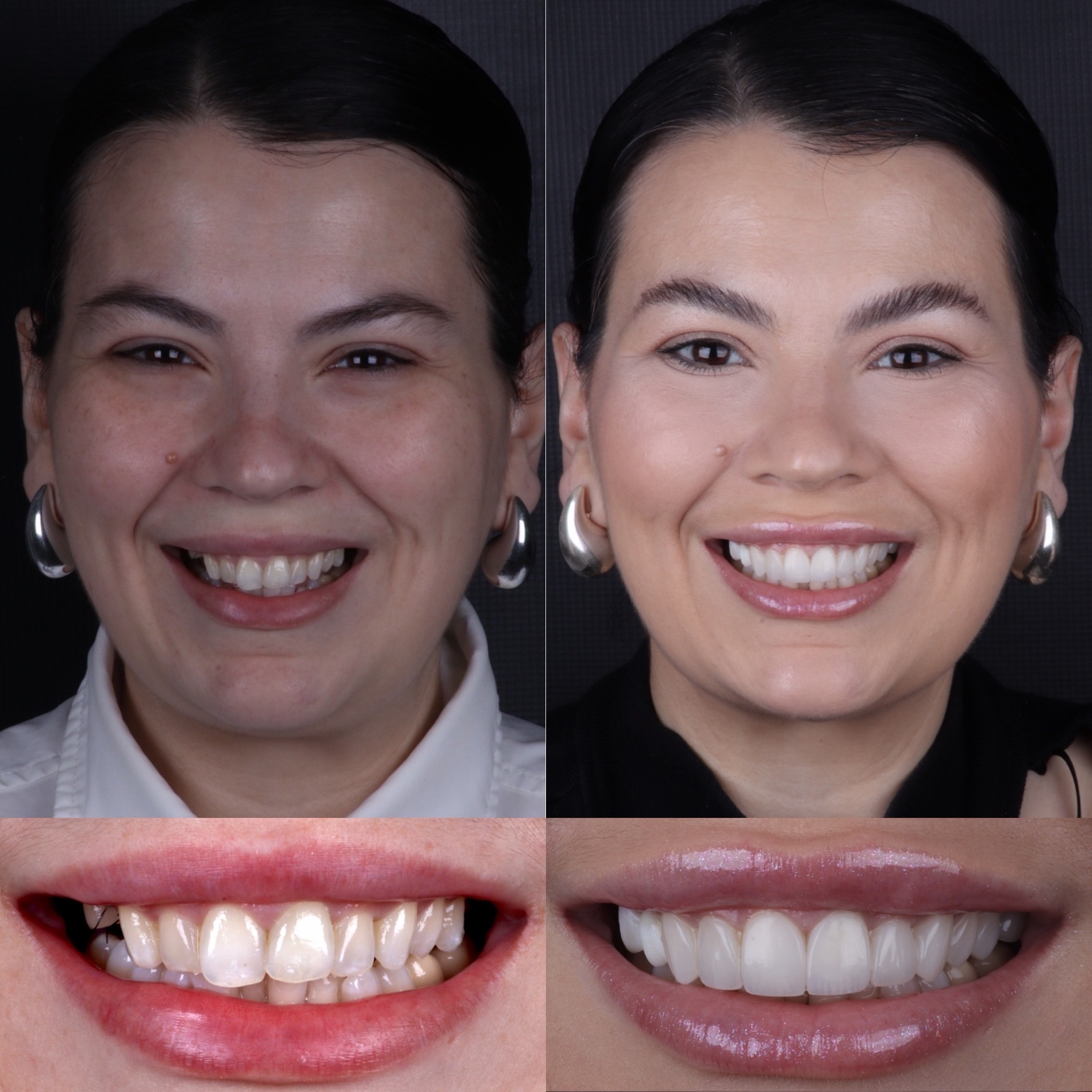 Caso real 08 — antes e depois, Dra. Paola Abe