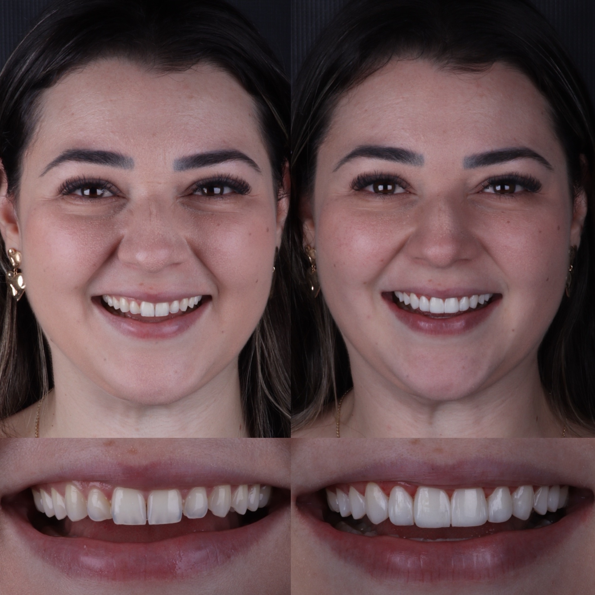 Caso real 09 — antes e depois, Dra. Paola Abe