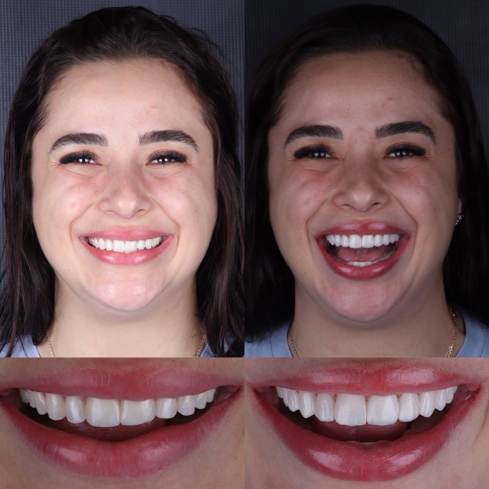Caso real 10 — antes e depois, Dra. Paola Abe